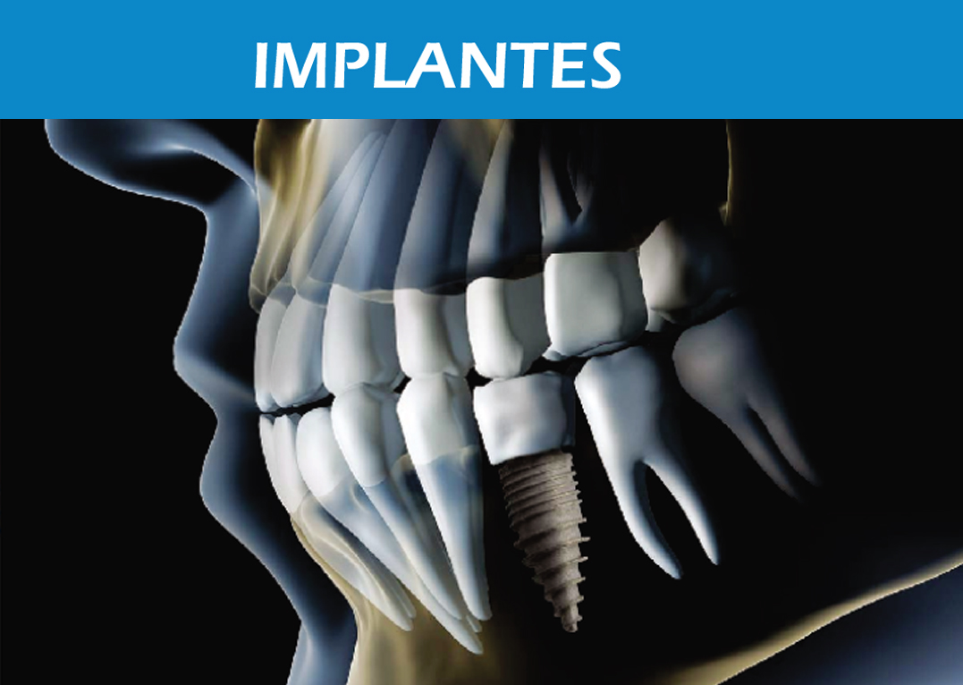 Implantes2